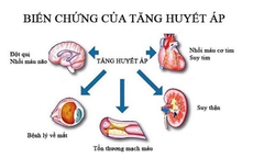 Người phụ nữ 35 tuổi ở Hà Nội bị suy thận, cao huyết áp thừa nhận một sai lầm nhiều người Việt mắc phải