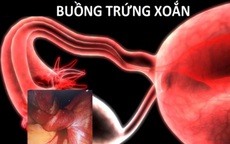 Bé 13 tuổi ở Bình Dương suýt bị hoại tử buồng trứng từ dấu hiệu nhiều người Việt bỏ qua