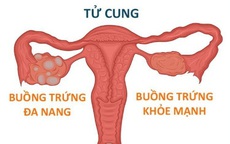 Cô gái 18 tuổi ở Hà Nội bất ngờ phát hiện buồng trứng đa nang từ dấu hiện nhiều phụ nữ Việt bỏ qua