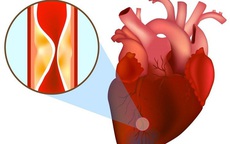 Bệnh nhân bị nhồi máu cơ tim cấp may mắn được cứu sống nhờ nhanh chóng làm việc này