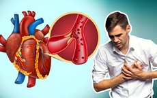 Người đàn ông 52 tuổi ở Quảng Ninh đột ngột lên cơn nhồi máu cơ tim trong tình huống nguy cấp, bác sĩ cân não xử trí
