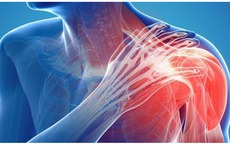 Viêm khớp vai: Cảnh giác với dấu hiệu nhiều người Việt bỏ qua