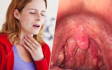 Cách phòng ngừa bệnh viêm họng cấp lúc giao mùa đơn giản mà hiệu quả nhất