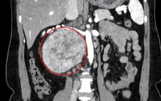Nhầm lẫn đau lưng do tập thể thao, người phụ nữ đi khám phát hiện khối u 'khổng lồ'