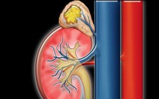Thanh niên 16 tuổi bị tăng huyết áp kéo dài, bác sĩ tìm ra nguyên nhân bất ngờ