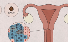 5 nhóm phụ nữ nên chú ý khám sàng lọc ung thư cổ tử cung