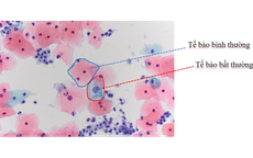 Đi khám xương khớp nghĩ bệnh tuổi trung niên, người phụ nữ 52 tuổi bất ngờ phát hiện tiền ung thư cổ tử cung