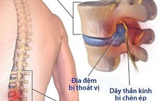 Thoái vị đĩa đệm cột sống lưng: Cần làm gì để hết đau?