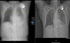 Đi khám vì đau ngực, người đàn ông 58 tuổi bất ngờ phát hiện tràn dịch màng phổi
