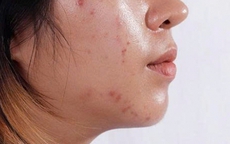 Cách làm sạch dầu trên da mặt an toàn và hiệu quả