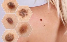 Người phụ nữ 45 tuổi phát hiện bị ung thư da từ một dấu hiệu trên mí mắt, rất dễ bị bỏ qua