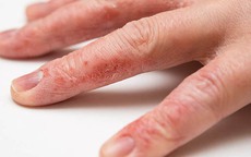 Làm cách nào để khắc phục da tay khô nứt nẻ vào mùa đông?