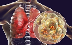 Liên tiếp nhập viện vì viêm phổi khi trời lạnh: Dấu hiệu cảnh báo bệnh, người cao tuổi tuyệt đối không bỏ qua