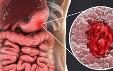 Người phụ nữ 41 tuổi phát hiện ung thư dạ dày từ dấu hiệu rối loạn tiêu hóa mà nhiều người Việt vẫn xem nhẹ