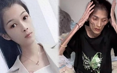 Bệnh gì khiến người phụ nữ 27 tuổi cao 1,6m nhưng chỉ nặng 17,5kg bị "teo dạ dày" và qua đời: BS khuyến cáo loại vi khuẩn có liên quan
