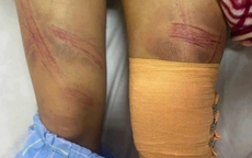 Bé gái 12 tuổi bị bố đánh nhập viện