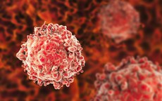 Tế bào ung thư phát triển thế nào trong cơ thể? Hiểu đúng để giảm nguy cơ mắc bệnh