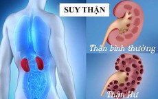 7 thói quen đơn giản giúp giảm nguy cơ suy thận người Việt nên làm