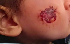 Bé gái 3 tuổi bị bỏng rộp cả mặt vì 'miếng dán đồ chơi': Nhiều đồ chơi hot trên mạng tuyệt đối không mua