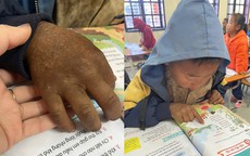 Hình ảnh bàn tay nứt nẻ của cậu bé 8 tuổi vùng cao khiến triệu người nghẹn lại