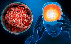 Người phụ nữ đột quỵ lúc nửa đêm có biểu hiện trước 10 ngày, nhưng dấu hiệu này nhiều người Việt rất dễ bỏ qua