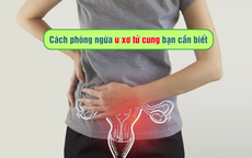 Cách phòng ngừa u xơ tử cung bạn cần biết