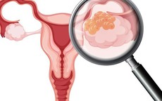 Giai đoạn sớm và quá trình tiến triển của ung thư buồng trứng