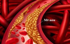 Cảnh giác với rối loạn mỡ máu sau Tết, U50 nhất định phải biết điều này