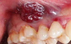 8 dấu hiệu cảnh báo ung thư khoang miệng
