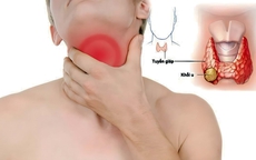 Người đàn ông 49 tuổi bất ngờ phát hiện bệnh tuyến giáp từ dấu hiệu nhiều người Việt bỏ qua