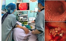Đau bụng, ợ hơi, người phụ nữ 48 tuổi đi khám phát hiện hơn 100 polyp mọc chi chít trong dạ dày