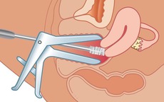 Người phụ nữ 35 tuổi đang khỏe mạnh bỗng phát hiện sớm ung thư cổ tử cung nhờ làm việc này