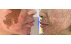 Trị nám 'cấp tốc': Trào lưu nguy hiểm từ các cơ sở thẩm mỹ 'chui'