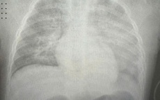 Bé gái 8 tuổi sốc nhiễm trùng, suy gan, phổi trắng xóa sau 6 giờ nhập viện vì biến chứng sởi