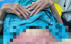 Tự điều trị viêm 'vùng kín', người phụ nữ ở Lạng Sơn bỏng nặng, lở loét toàn bộ vùng sinh dục