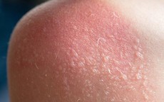 Cách khắc phục làn da bị cháy nắng