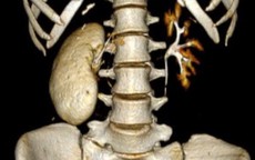 Cô gái 18 tuổi có thận 'hóa đá' và những sai lầm tàn phá thận một cách nhanh chóng của nhiều người
