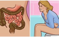 8 dấu hiệu ung thư trực tràng dễ nhận biết nhưng thường bị bỏ qua