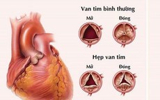 Người đàn ông ở Phú Thọ bị hỏng van tim, tự tin lên bàn mổ khi được bác sĩ áp dụng phương pháp ít xâm lấn