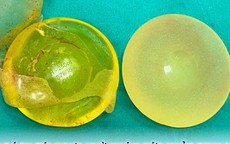 Đi khám sức khỏe định kỳ, người phụ nữ 50 tuổi phát hiện vỡ túi ngực silicon mà không biết