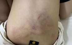 Điều tra vụ bé gái 4 tuổi nghi bị cô giáo bạo hành ở Hà Nội