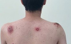 Nam nhân viên văn phòng lở loét toàn thân vì quan hệ tình dục bừa bãi
