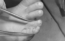 Bé 56 tháng tuổi bị dị tật bẩm sinh hiếm gặp