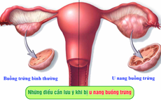 Những điều cần lưu ý khi bị u nang buồng trứng