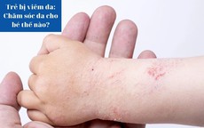 Trẻ bị viêm da: Chăm sóc da cho bé thế nào?