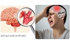 Bác sĩ cảnh báo: Trước 3 ngày nhồi máu não, 90% bệnh nhân đều làm 3 việc này, việc thứ hai bạn vẫn đang làm hàng ngày!