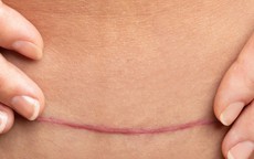 Để vết mổ sau sinh mau lành và không để lại sẹo