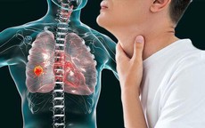 Người đàn ông 60 tuổi bất ngờ phát hiện ung thư phổi từ dấu hiệu nhiều người Việt mắc phải, nhưng đều bỏ qua