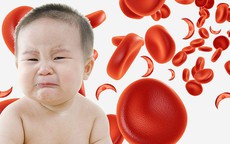5 triệu chứng cảnh báo thiếu sắt ở trẻ em cha mẹ dễ bỏ qua và cách bổ sung an toàn