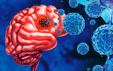 Đi khám vì đau đầu, thanh niên 19 tuổi ở Phú Thọ phát hiện bệnh nguy hiểm hiếm gặp